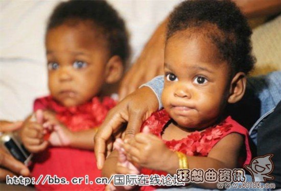 近年来，世界各地都出现有关连体双胞胎的报道，每次都能吸引很多人关注的目光。通过手术，报道中提到的一些连体双胞胎成功分离。连体姐妹花艾比·亨瑟尔和布列塔尼·亨瑟尔。