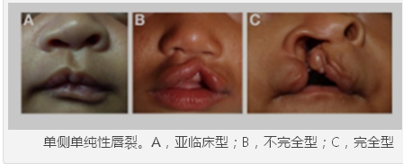 【科学姐】李嫣兔唇这事儿 真不能全怪王菲