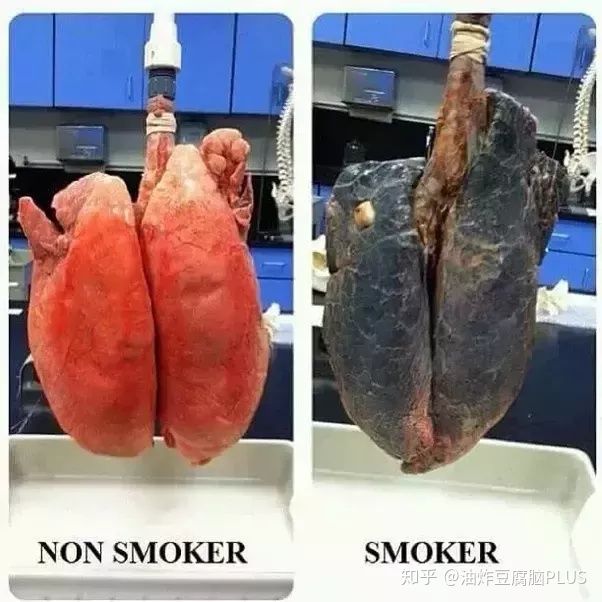 戒烟三个月肺部图片有何变化,戒烟多久情绪才会稳定?