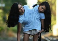 连体人一个去世另一个怎么办？连体人犯罪怎么